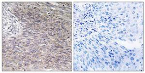 Immunohistochemical analysis of paraffin-embedded human cervix carcinoma tissue using Anti-CHSY2 Antibody. The right hand panel represents a negative control, where the antibody was pre-incubated with the immunising peptide