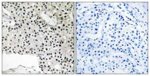 Immunohistochemical analysis of paraffin-embedded human breast carcinoma using Anti-TCEAL4 Antibody The right hand panel represents a negative control, where the antibody was pre-incubated with the immunising peptide