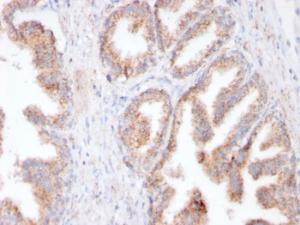 Immunohistochemical analysis of formalin-fixed, paraffin-embedded human prostate carcinoma using Anti-PSMA Antibody [FOLH1/3149R]