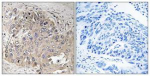 Immunohistochemical analysis of paraffin-embedded human lung carcinoma using Anti-SPTBN5 Antibody. The right hand panel represents a negative control, where the antibody was pre-incubated with the immunising peptide.