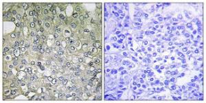 Immunohistochemical analysis of paraffin-embedded human breast carcinoma tissue using Anti-ADRA1D Antibody. The right hand panel represents a negative control, where the Antibody was pre-incubated with the immunising peptide