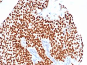 Immunohistochemical analysis of formalin-fixed, paraffin-embedded human bladder carcinoma tissue using Anti-GATA3 Antibody [GATA3/4550R]