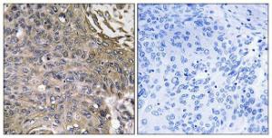 Immunohistochemical analysis of paraffin-embedded human lung carcinoma using Anti-SH2D1B Antibody. The right hand panel represents a negative control, where the Antibody was pre-incubated with the immunising peptide