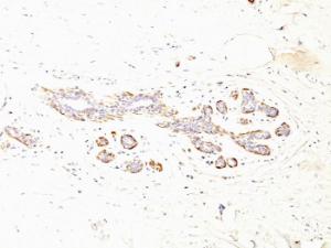 Immunohistochemical analysis of formalin-fixed, paraffin-embedded human breast carcinoma using Anti-MYH11 Antibody [MYH11/923 + SMMS-1]