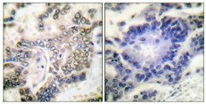 Immunohistochemical analysis of paraffin-embedded human lung carcinoma tissue using Anti-CEBP alpha Antibody. The right hand panel represents a negative control, where the antibody was pre-incubated with the immunising peptide