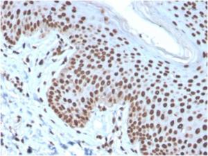 Immunohistochemical analysis of formalin-fixed, paraffin-embedded human basal cell carcinoma using Anti-Histone H1 Antibody [rAE-4]