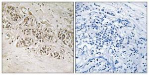 Immunohistochemical analysis of paraffin-embedded human breast carcinoma using Anti-RAD54B Antibody. The right hand panel represents a negative control, where the antibody was pre-incubated with the immunising peptide