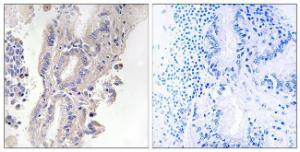 Immunohistochemical analysis of paraffin-embedded human lung carcinoma using Anti-PLCXD1 Antibody. The right hand panel represents a negative control, where the antibody was pre-incubated with the immunising peptide