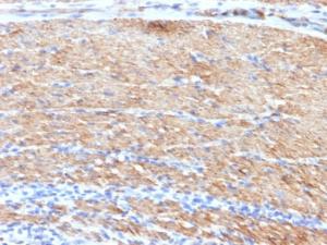 Immunohistochemical analysis of formalin-fixed, paraffin-embedded human colon carcinoma using Anti-MYH11 Antibody [MYH11/923 + SMMS-1]