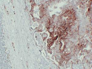 Immunohistochemical analysis of paraffin-embedded human Colon carcinoma using Anti-GLUT 1 Antibody