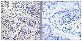 Immunohistochemical analysis of paraffin-embedded human lung cancer using Anti-PLCXD1 Antibody 1:100 (4°C overnight). The right hand panel represents a negative control, where the antibody was pre-incubated with the immunising peptide