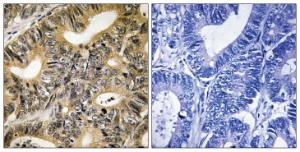 Immunohistochemical analysis of paraffin-embedded human colon carcinoma tissue using 4E-BP1 (Phospho-Thr70) antibody (left) or the same antibody preincubated with blocking peptide (right).