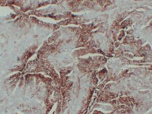 Immunohistochemical analysis of paraffin-embedded human Colon carcinoma using Anti-GLUT 1 Antibody