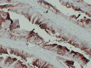 Immunohistochemical analysis of paraffin-embedded human Colon carcinoma using Anti-GLUT 1 Antibody