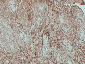 Immunohistochemical analysis of paraffin-embedded human Mesothelioma using Anti-CA 125 Antibody