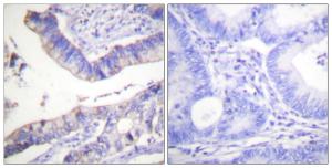 Immunohistochemical analysis of paraffin-embedded human colon carcinoma tissue using Anti-BCL-2 Antibody The right hand panel represents a negative control, where the antibody was pre-incubated with the immunising peptide