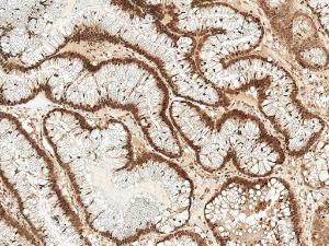 Immunohistochemistry analysis of human colon cancer, fixed in formalin and paraffin-embedded. The Primary Antibody used was Anti-Rac1 Antibody (A304869) at 1:50 for 30 minutes at room temperature. Counterstain: Hematoxylin. Magnification: 10X. HRP-DAB Detection