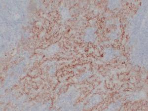 Immunohistochemical analysis of paraffin-embedded human Mesothelioma using Anti-CA 125 Antibody