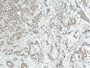 Immunohistochemistry analysis of human breast cancer, fixed in formalin and paraffin-embedded. The Primary Antibody used was Anti-CREBBP Antibody (A304870) at 1:50 for 30 minutes at room temperature. Counterstain: Hematoxylin. Magnification: 10X. HRP-DAB Detection