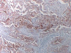 Immunohistochemical analysis of paraffin-embedded human Ovarian serous carcinoma using Anti-CA 125 Antibody