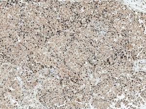 Immunohistochemistry analysis of human breast cancer, fixed in formalin and paraffin-embedded. The Primary Antibody used was Anti-CREBBP Antibody (A304870) at 1:50 for 30 minutes at room temperature. Counterstain: Hematoxylin. Magnification: 10X. HRP-DAB Detection