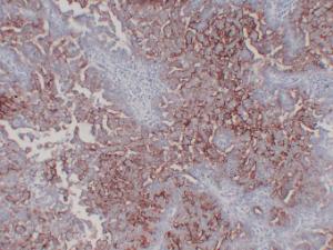 Immunohistochemical analysis of paraffin-embedded human Ovarian serous carcinoma using Anti-CA 125 Antibody