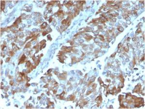 Immunohistochemical analysis of formalin-fixed, paraffin-embedded human renal cell carcinoma using Anti-CD134 Antibody [OX40/3108]