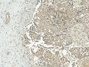 Immunohistochemistry analysis of human breast cancer, fixed in formalin and paraffin-embedded. The Primary Antibody used was Anti-CREBBP Antibody (A304871) at 1:50 for 30 minutes at room temperature. Counterstain: Hematoxylin. Magnification: 10X. HRP-DAB Detection