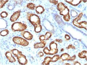 Immunohistochemical analysis of formalin-fixed, paraffin-embedded human renal cell carcinoma using Anti-AMACR Antibody [AMACR/3931R]