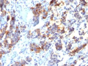 Immunohistochemical analysis of formalin-fixed, paraffin-embedded human gastric carcinoma using Anti-Mucin 5AC Antibody [45M1]