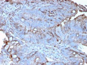 Immunohistochemical analysis of formalin-fixed, paraffin-embedded human colon carcinoma using Anti-MerTK Antibody [MERTK/3022]