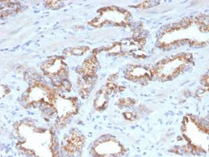 Immunohistochemical analysis of formalin-fixed, paraffin-embedded human prostate carcinoma using Anti-AMACR Antibody [AMACR/4572R]