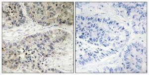 Immunohistochemical analysis of paraffin-embedded human lung carcinoma using Anti-MAPK15 Antibody. The right hand panel represents a negative control, where the Antibody was pre-incubated with the immunising peptide