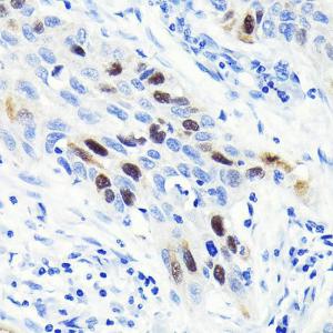 Immunohistochemistry analysis of paraffin-embedded human lung cancer using Anti-Cyclin A2 Antibody [ARC0359] (A308964) at a dilution of 1:100 (40X lens). Perform microwave antigen retrieval with 10 mM PBS buffer pH 7.2 before commencing with IHC staining protocol