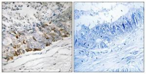 Immunohistochemical analysis of paraffin-embedded human colon carcinoma tissue using Anti-GCHFR Antibody The right hand panel represents a negative control, where the antibody was pre-incubated with the immunising peptide