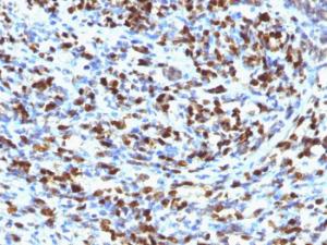 Immunohistochemical analysis of formalin-fixed, paraffin-embedded human rhabdomyosarcoma using Anti-Myogenin Antibody [MGN185]