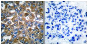 Immunohistochemical analysis of paraffin-embedded human breast carcinoma tissue using Anti-Keratin 15 Antibody. The right hand panel represents a negative control, where the antibody was pre-incubated with the immunising peptide