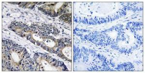 Immunohistochemical analysis of paraffin-embedded human colon carcinoma using Anti-GLB1L3 Antibody. The right hand panel represents a negative control, where the antibody was pre-incubated with the immunising peptide.