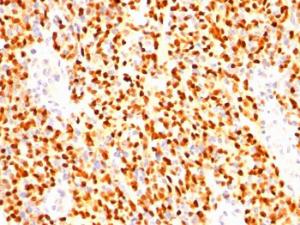 Immunohistochemical analysis of formalin-fixed, paraffin-embedded human rhabdomyosarcoma using Anti-Myogenin Antibody [SPM144]