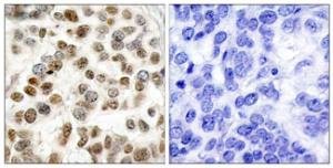 Immunohistochemical analysis of paraffin-embedded human breast carcinoma tissue using Anti-BRCA1 Antibody. The right hand panel represents a negative control, where the antibody was pre-incubated with the immunising peptide.