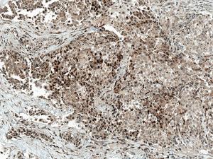 Immunohistochemistry analysis of human breast cancer, fixed in formalin and paraffin-embedded. The Primary Antibody used was Anti-c-Jun Antibody (A304877) at 1:50 for 30 minutes at room temperature. Counterstain: Hematoxylin. Localization: Nucleus. Magnification: 10X. HRP-DAB Detection.