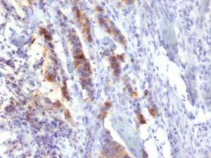 Immunohistochemical analysis of formalin-fixed, paraffin-embedded human gastric carcinoma using Anti-Mucin 5AC Antibody [SPM488]