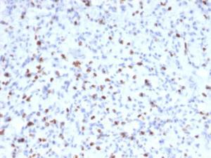 Immunohistochemical analysis of formalin-fixed, paraffin-embedded human rhabdomyosarcoma using Anti-Myogenin Antibody [MYOG/2660]