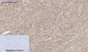 Immunohistochemical analysis of paraffin-embedded human uterus cancer tissue using Anti-BRCA1 Antibody at 1:200 (4°C overnight). Negative control was secondary antibody only.