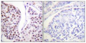 Immunohistochemical analysis of paraffin-embedded human breast carcinoma tissue using Anti-Histone H4 Antibody. The right hand panel represents a negative control, where the antibody was pre-incubated with the immunising peptide.