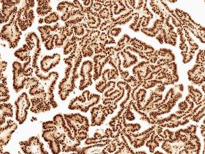 Immunohistochemistry analysis of human thyroid carcinoma, fixed in formalin and paraffin-embedded. The Primary Antibody used was Anti-Wnt5a Antibody (A304879) at 1:50 for 30  minutes at room temperature. Counterstain: Hematoxylin. Magnification: 10X. HRP-DAB Detection