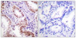 Immunohistochemical analysis of paraffin-embedded human lung carcinoma tissue using Anti-Histone H3 Antibody. The right hand panel represents a negative control, where the antibody was pre-incubated with the immunising peptide.