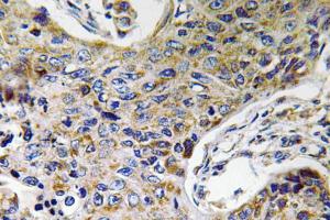 Immunohistochemical analysis of paraffin-embedded human lung carcinoma tissue using Anti-ATP5J2 Antibody