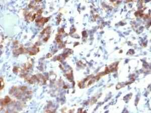 Immunohistochemical analysis of formalin-fixed, paraffin-embedded human gastric carcinoma using Anti-Mucin 5AC Antibody [MUC5AC/917 + 45M1]