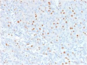 Immunohistochemical analysis of formalin-fixed, paraffin-embedded human bladder carcinoma using Anti-Annexin A1 Antibody [6E4/3]